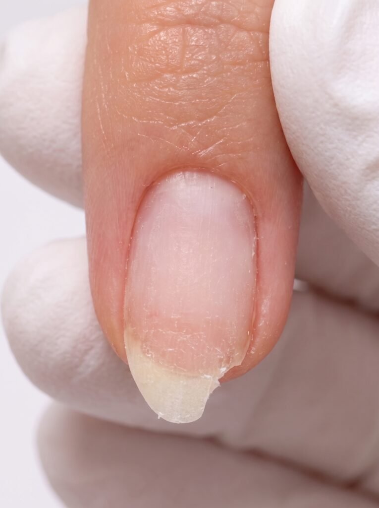 A cracked natural fingernail requiring an emergency fix with professional nail glue